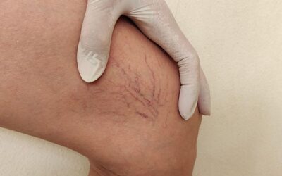 A COMPREHENSIVE GUIDE TO SPIDER VEIN REMOVAL